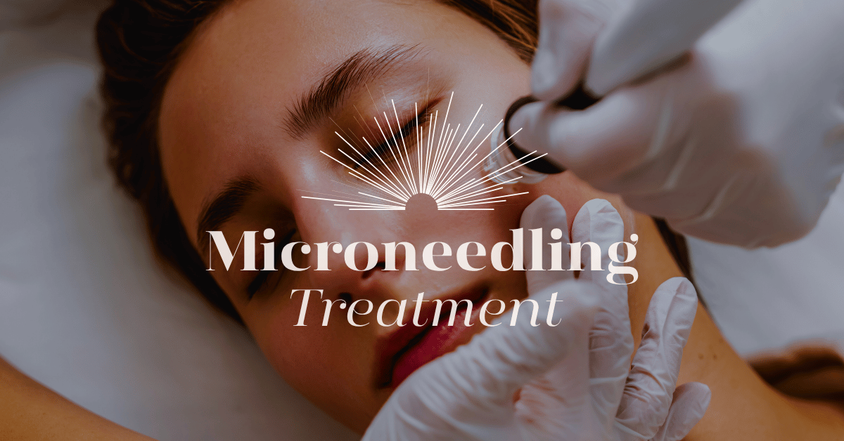 Microneedling Treatments for Cleansing Skin in Kilcullen in MC Beauty House Marta Czarnecka