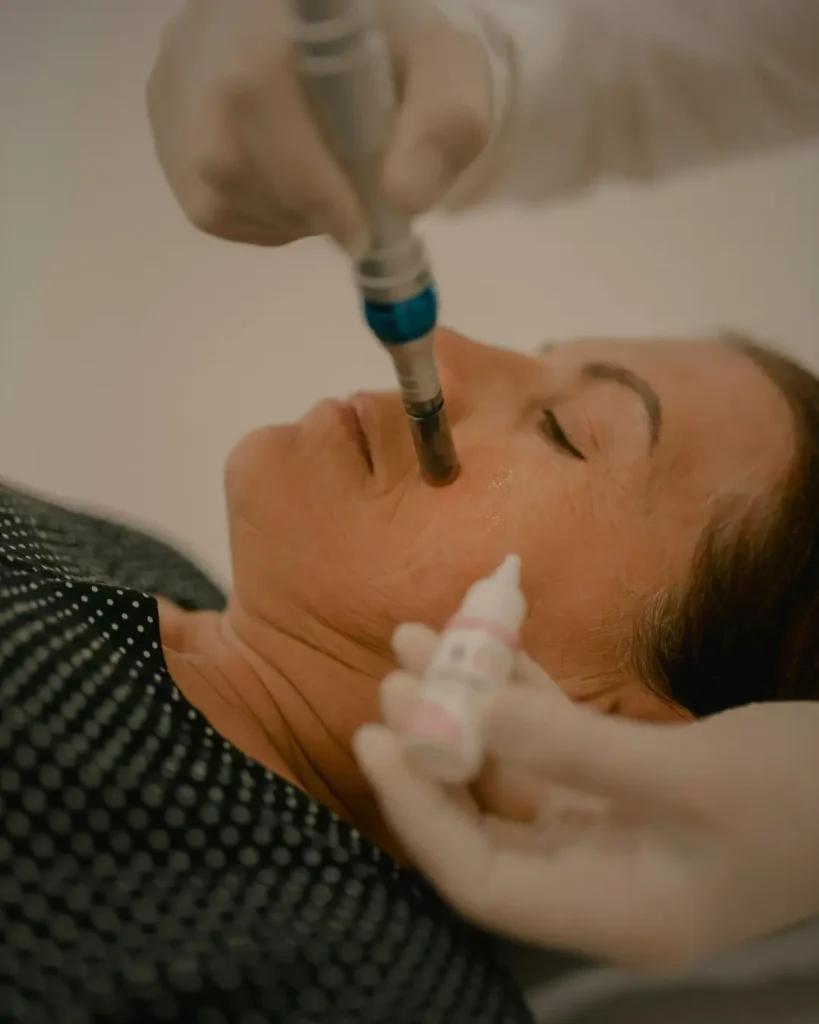 Microneedling Treatment For Skin Cleansing and stimulate Collagen in Kilcullen